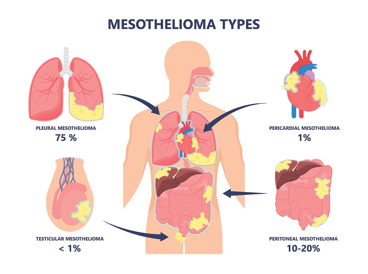 types of cancer asbestos causes